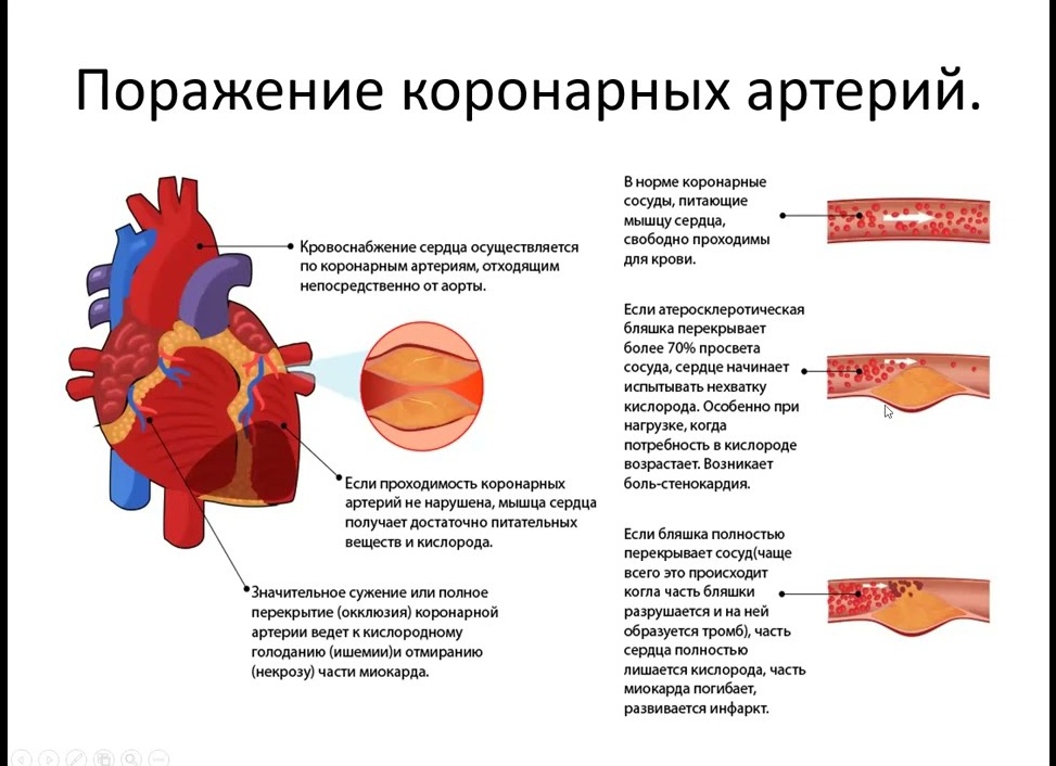 Инфаркт: когда сердцу не хватает кислорода