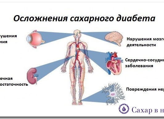 Сердечнососудистые осложнения сахарного диабета: с какими проблемами сталкиваются пациенты и как их избежать