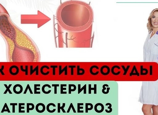 Атеросклероз. Повышенный холестерин. Как очистить сосуды