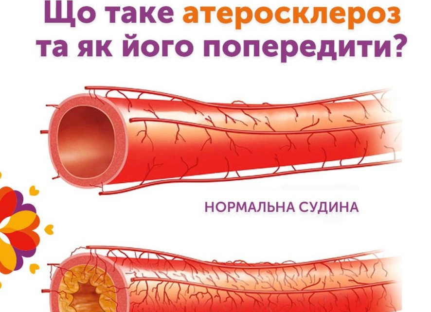 Атеросклероз: что это и как его лечить?