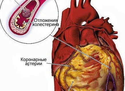 Сколько лет живут люди с атеросклерозом??