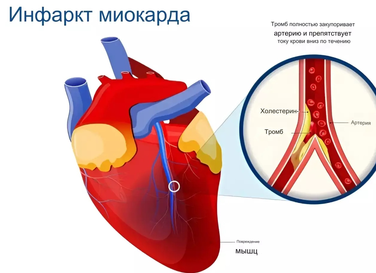 Инфаркт миокарда