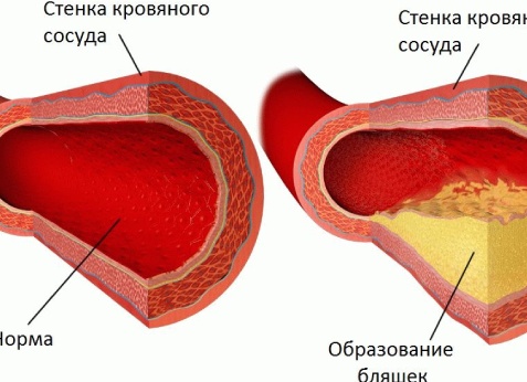 Атеросклероз: ранняя диагностика воспаления