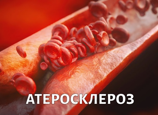 Кому грозит атеросклероз?