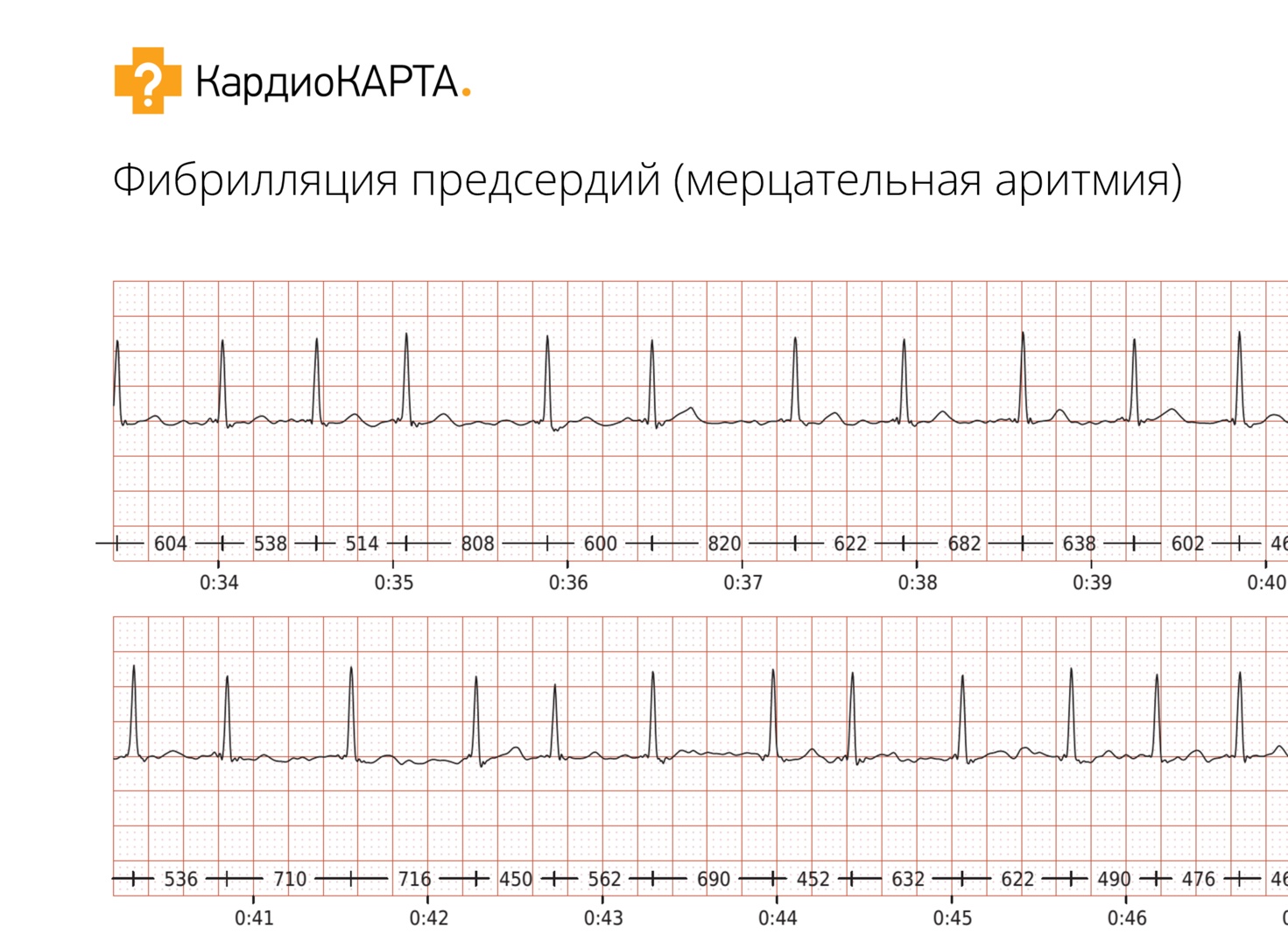 ЗДОРОВЬЕ СЕРДЦА. ТАХИКАРДИЯ.</p>
<p>БРАДИКАРДИЯ. ЭКСТРАСИСТОЛИЧЕСКАЯ АРИТМИЯ