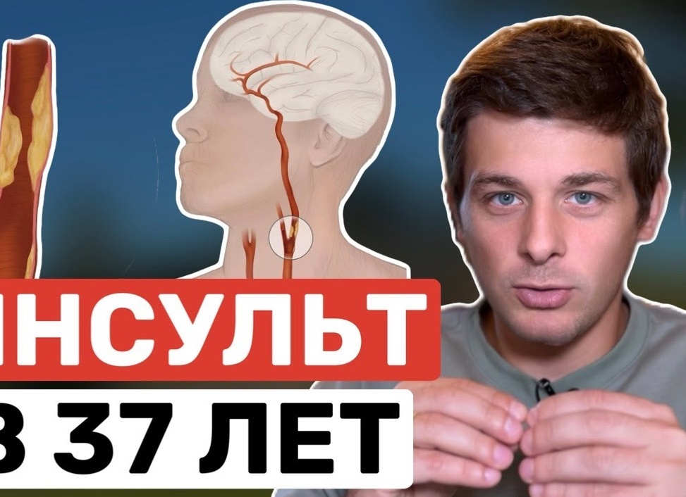 Инсульт в 37 лет? Атеросклероз сонных артерий: безмолвный убийца.