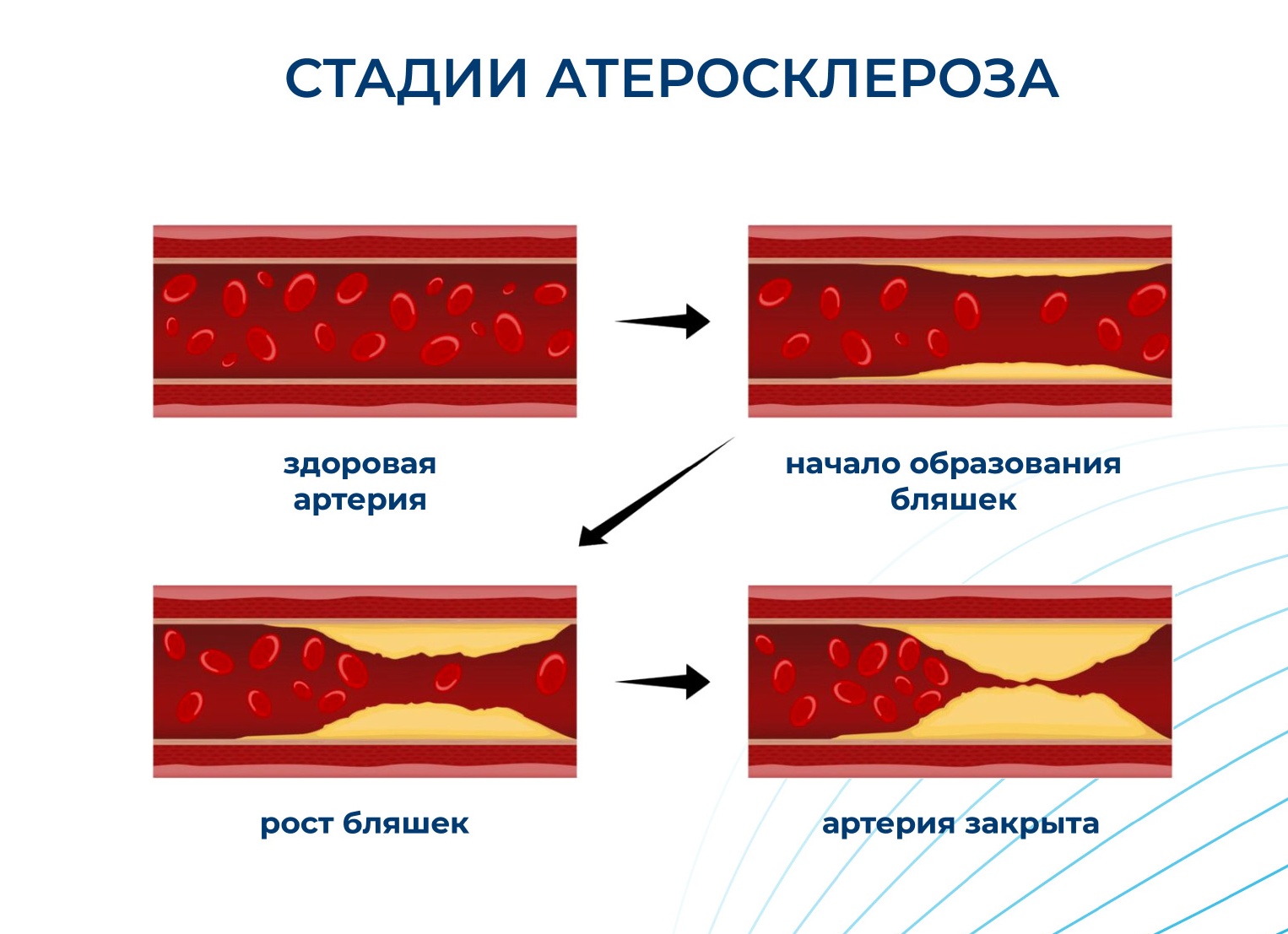 Блокада аорты – причины, симптомы и последствия