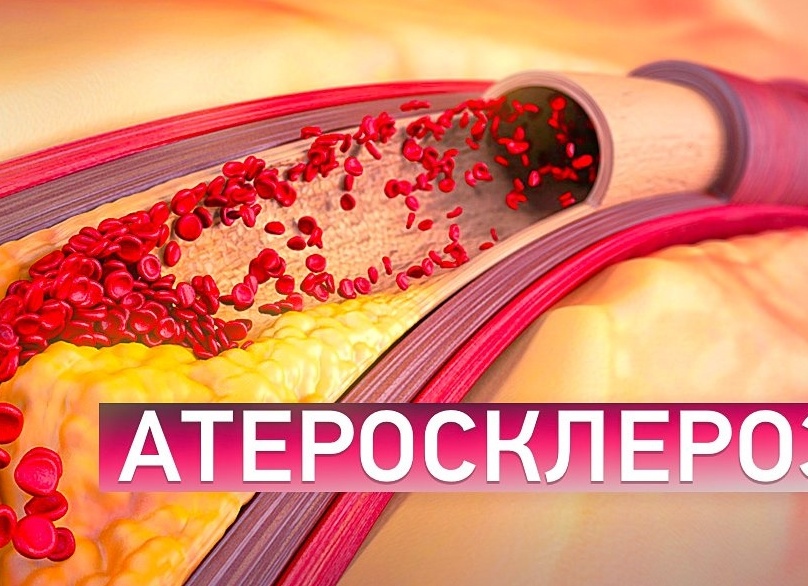 Атеросклероз. Профилактика, лечение.