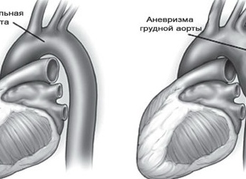 Уплотнение аорты и её заболевания: что вы должны знать