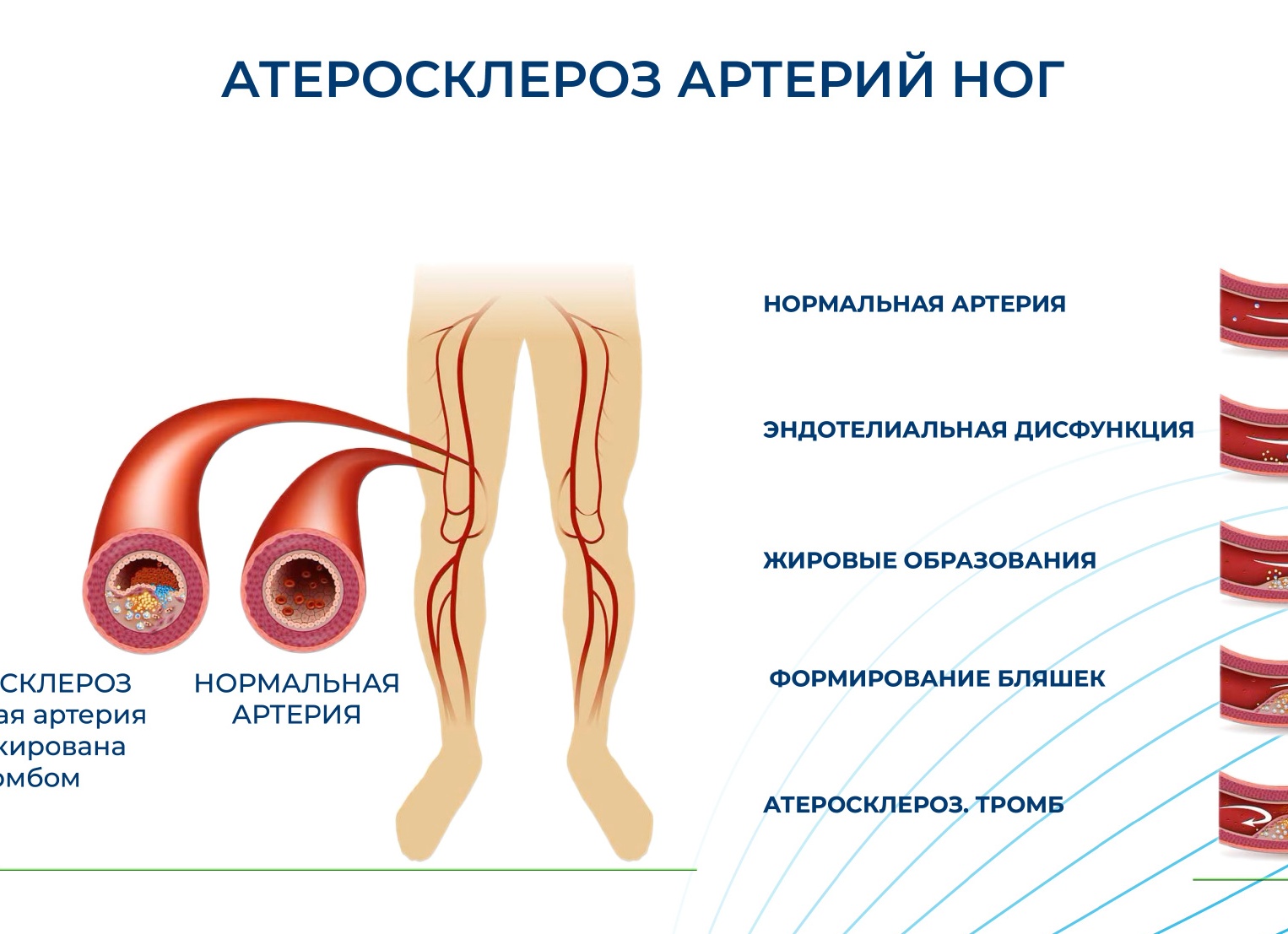 АТЕРОСКЛЕРОЗ