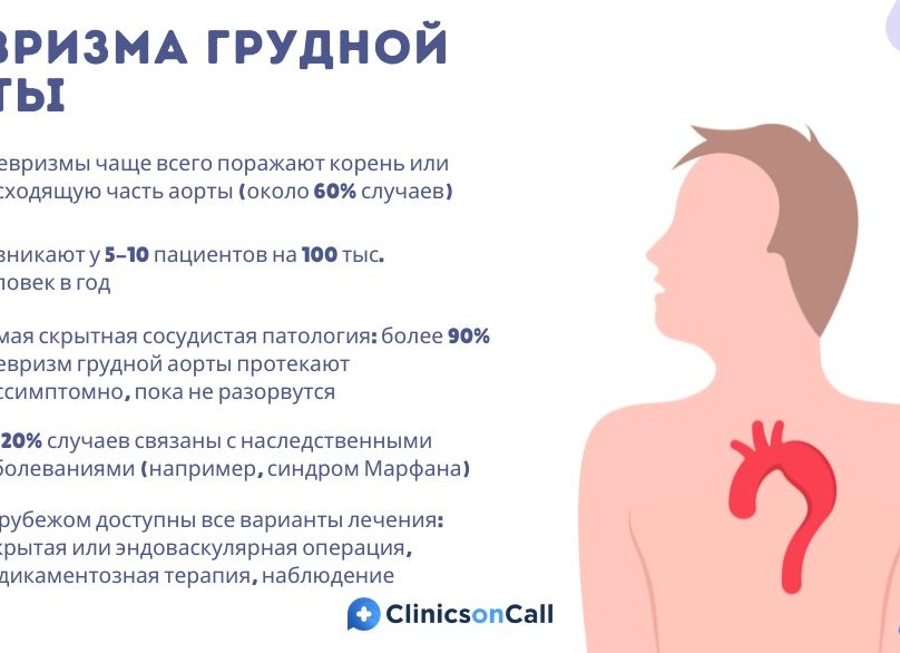 Что такое аневризма аорты, причины возникновения