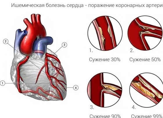 Ишемическая болезнь сердца