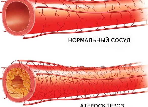 Атеросклероз аорты