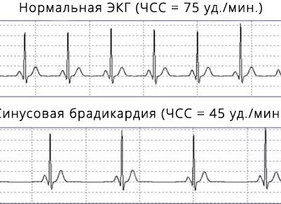 Брадикардия: когда редкий пульс – это норма, а когда – повод насторожиться