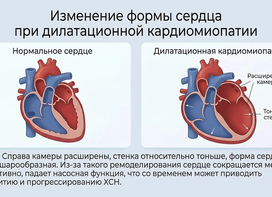 Кардиомиопатия: когда сердце устаёт биться — что делать и как помочь себе