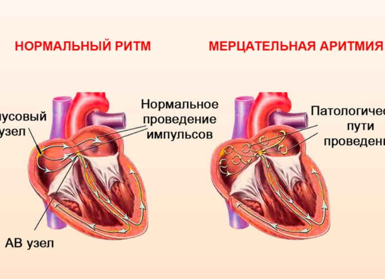 Как лечить аритмию сердца?