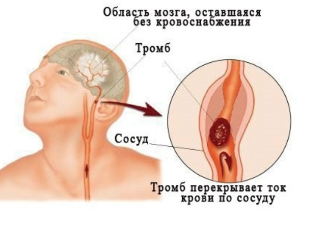 Нарушение кровообращения: причины, симптомы и лечение