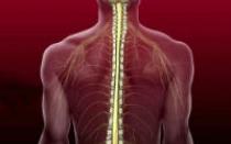 Adamkevich'in büyük radiküler arteri ve Desproges-Getteron'un aksesuar radikülo-medüller arterinin havzasında spinal iskemik inme
