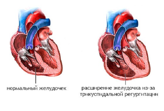 Регургитация 1 степени что это. Регургитация трехстворчатого клапана степени. Трикуспидальный клапан сердца 1 степени. Регургитация трехстворчатого клапана 1 степени что это такое. Трикуспидальный клапан регургитация.