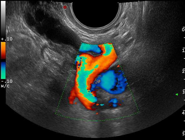 Варикозное расширение малого. Варикоз вен малого таза УЗИ. Расширение вен малого таза УЗИ. Варикозное расширение вен малого таза у женщин УЗИ. Варикоз вен малого таза эхограмма.