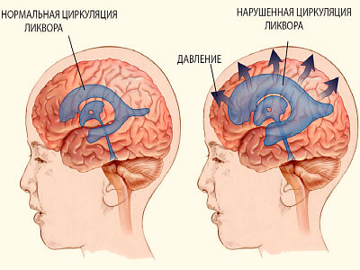 Картина смешанной гидроцефалии. Гидроцефалия нормального давления. Открытая и закрытая гидроцефалия. Пути оттока ликвора. Повреждение мозга при гидроцефалии.