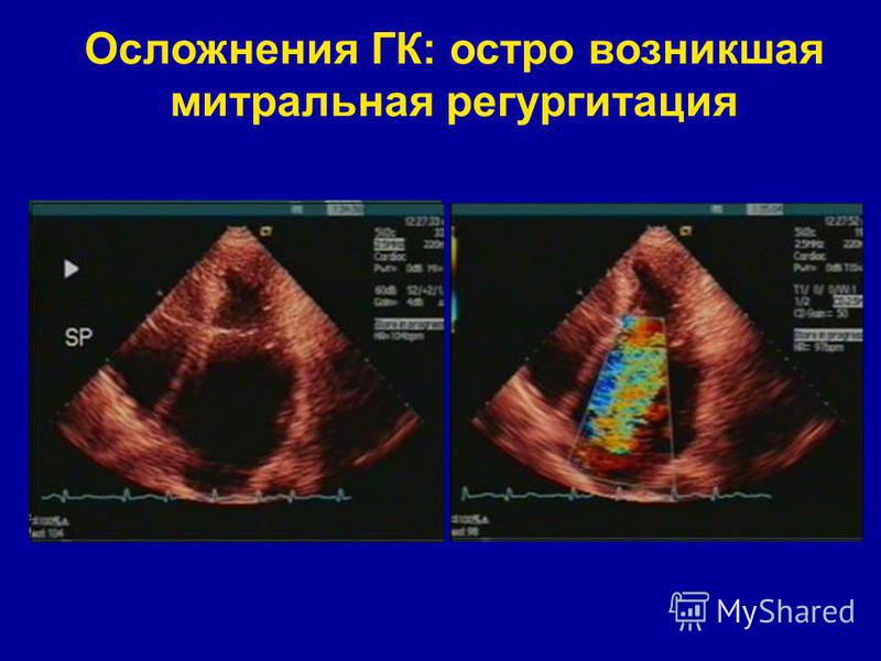 Митральная регургитация 2 степени. Острая митральная регургитация. Митральная регургитация ЭХОКГ. Инфаркт митрального клапана. Эхо кг артериальная гипертензия.