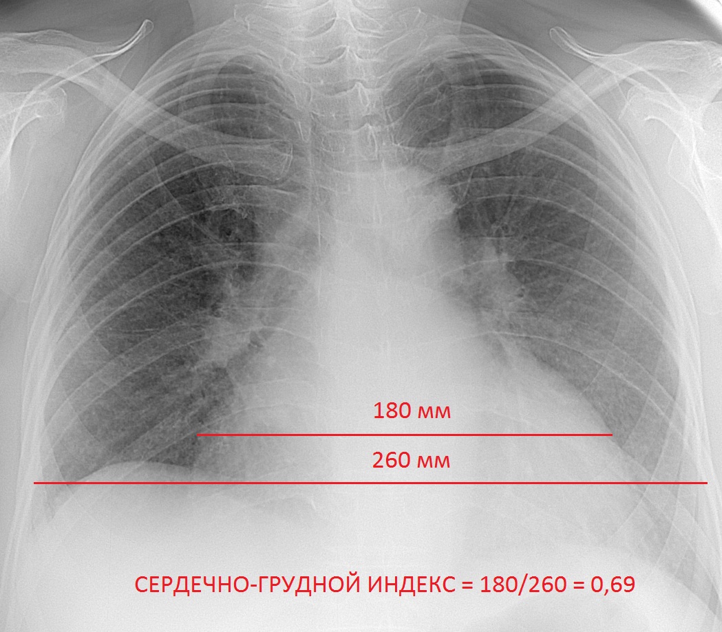 Рентген сердца. КТИ норма в рентгене. Нормальная рентгенограмма сердца. Рентген сердца норма.