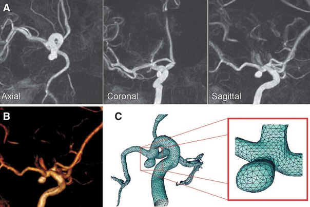 Мешотчатые аневризмы вса. Сегменты позвоночной артерии мрт. Аневризма сонной артерии мрт. Аневризма головного мозга на кт. Аневризма сифона ВСА мрт.